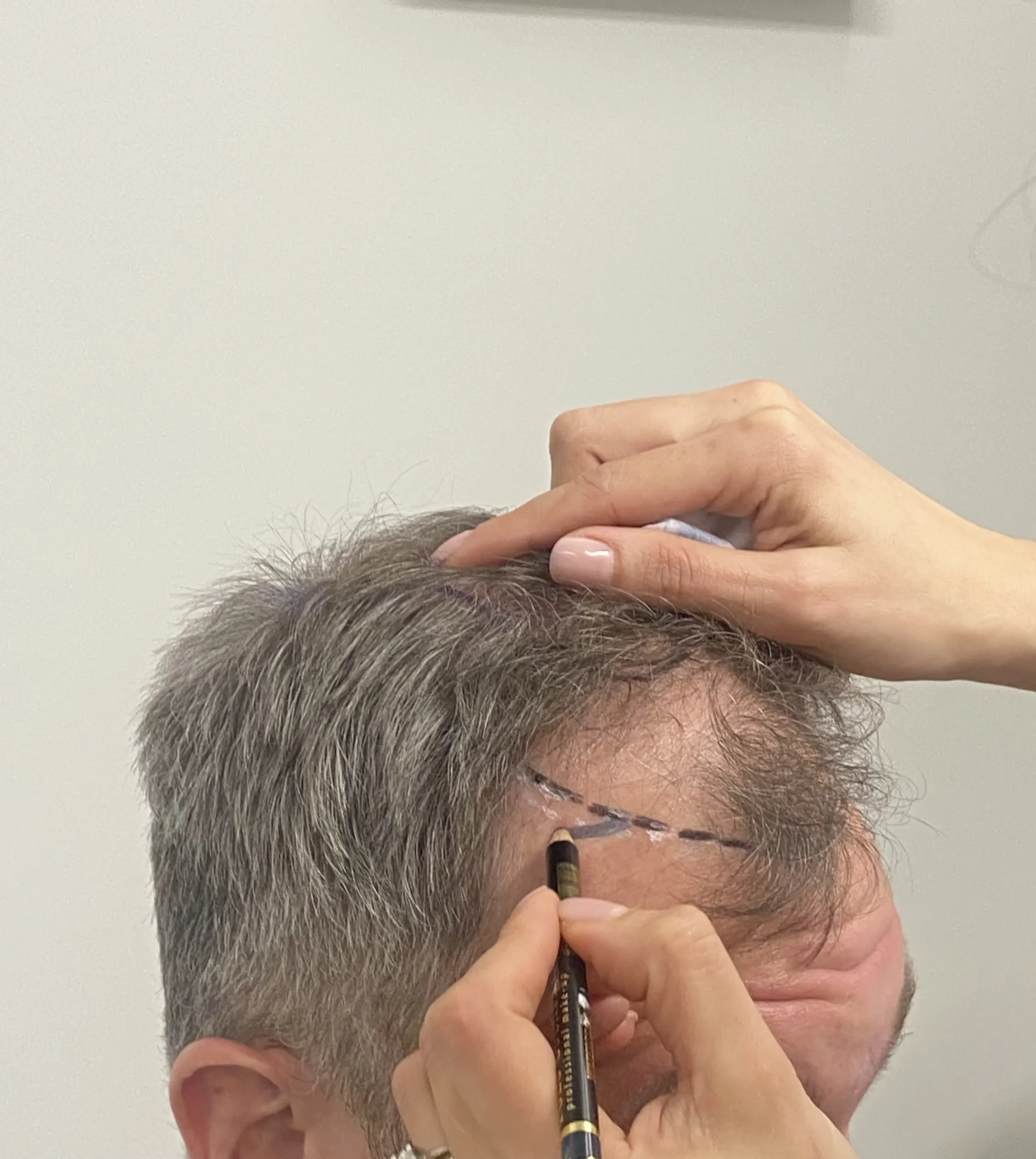 Sapphire FUE Hair Transplantation