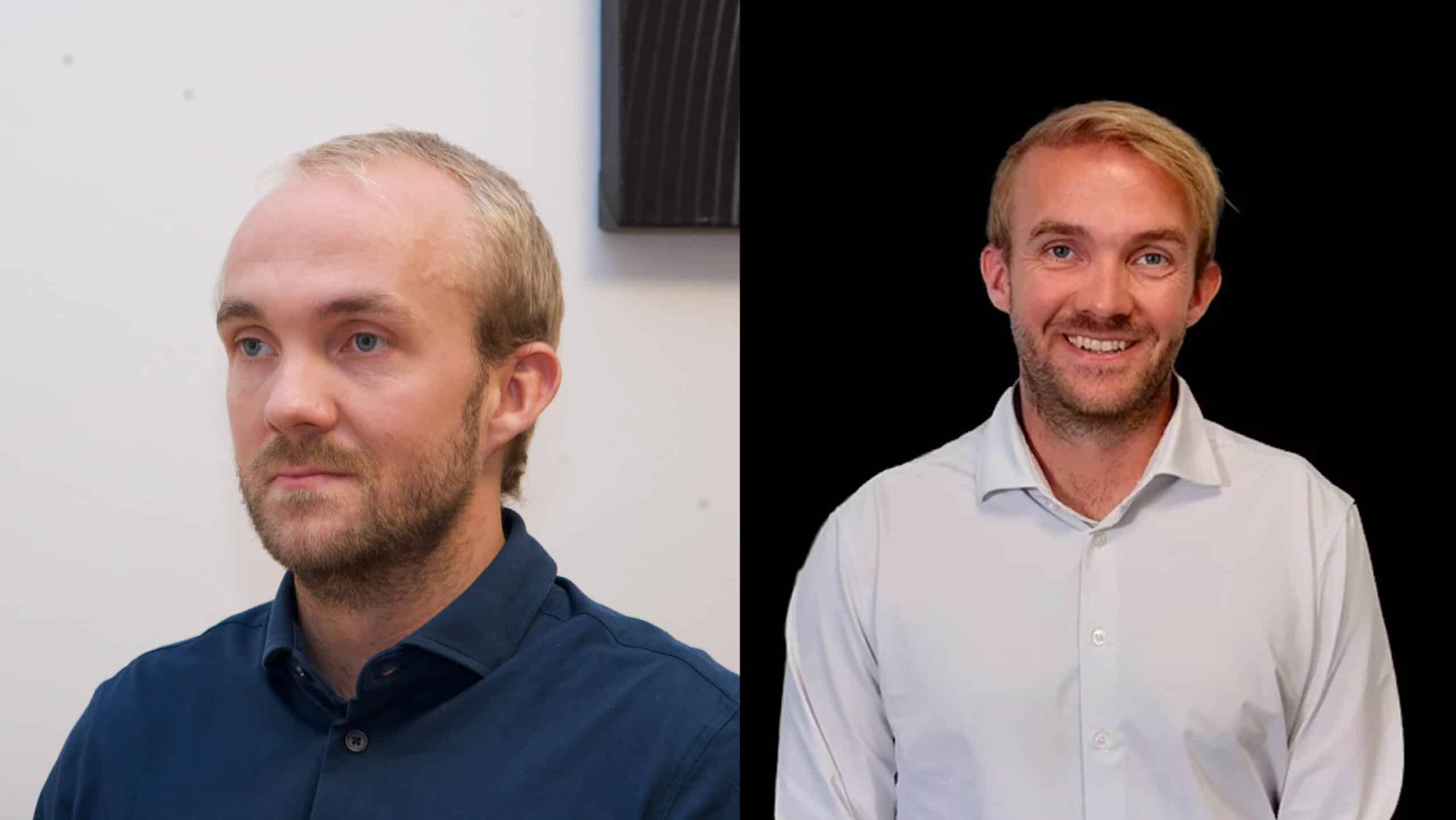 Daniels historie i TV 2: Fra hårtab til hårtransplantation